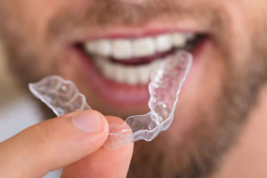 Can Invisalign Fix An Underbite?